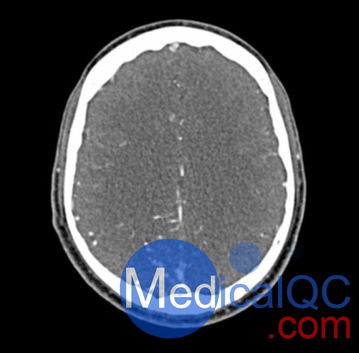 WEK50-04 CTA頭模，帶AVM CTA頭模，WEK50-04 CT血管造影頭模成像效果圖