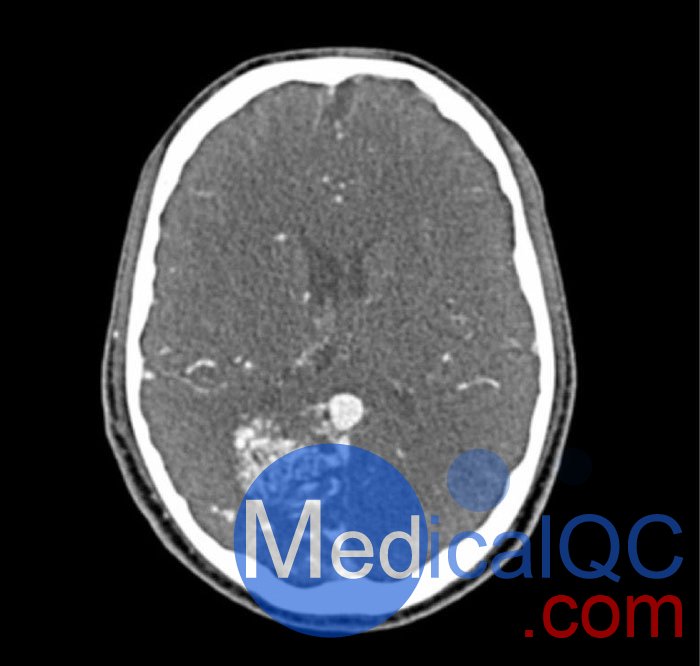 WEK-5005腦血管造影頭模，WEK-5005頭模， CTA AVM頭模成像效果圖