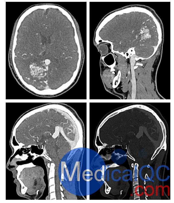 WEK51-04 CTA AVM頭部模體,WEK51-04 CT血管造影頭模成像效果圖