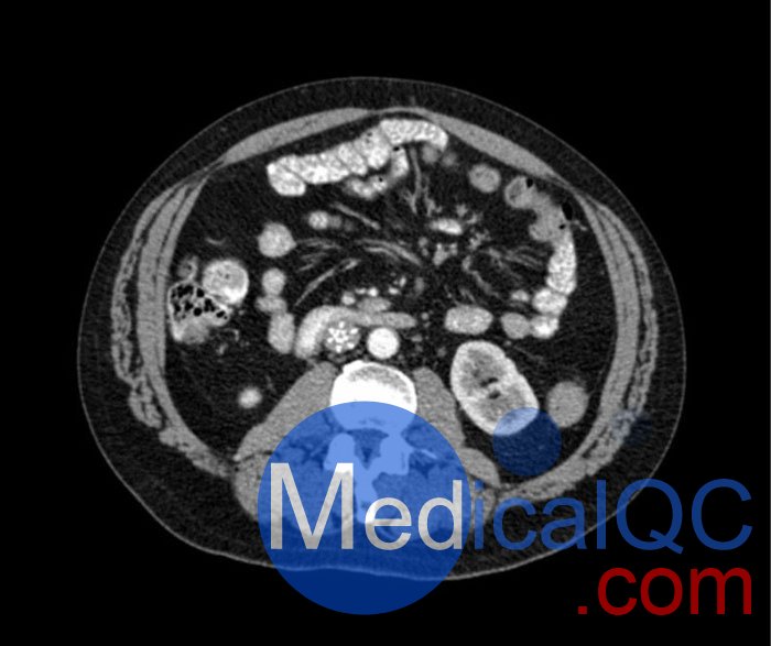 WEK53-04肝硬化腹部模體,WEK53-04門靜脈期腹部模體產(chǎn)品成像圖