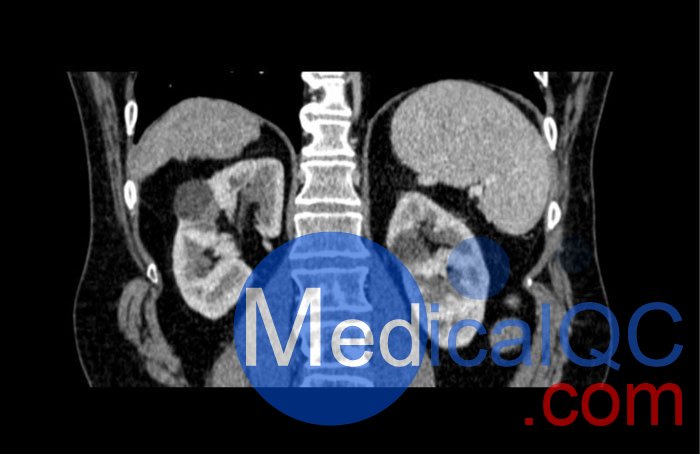 WEK53-04肝硬化腹部模體,WEK53-04門靜脈期腹部模體產(chǎn)品成像圖